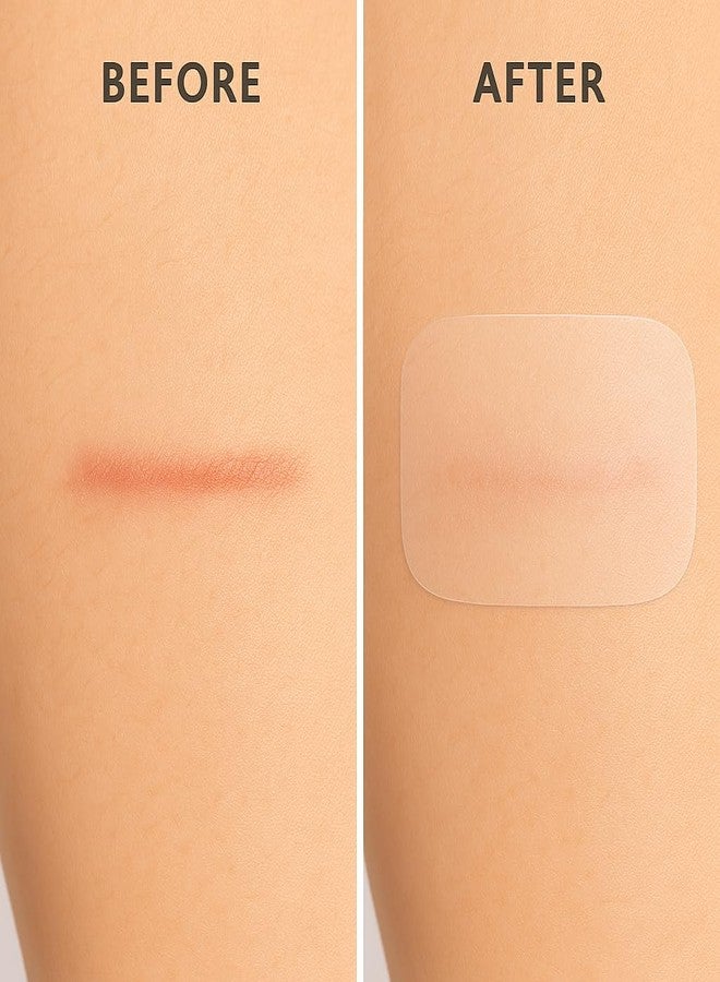 PUREEASE Silicone Scar Sheets – Reusable Medical-Grade Silicone Gel Strips for Body & Face – Soft, Invisible & Flexible – 1.4 x 4.3 in – 6 Clear Patches for Old & New Scars – Smoother Skin Appearance - Image 3